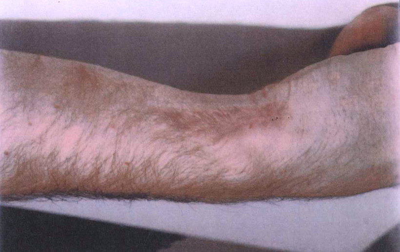 A cold burn on an injured party's arm